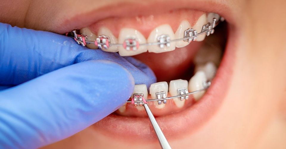 箍牙治療的不同階段是什麼？